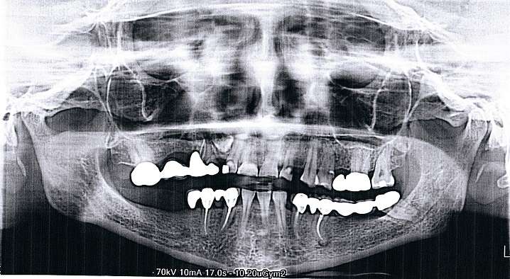 Пациентка 56 лет, обратилась в 2012 году по поводу отсутствия зубов на нижней челюсти справа​