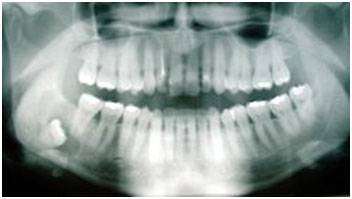 Удаление непрорезавшихся зубов